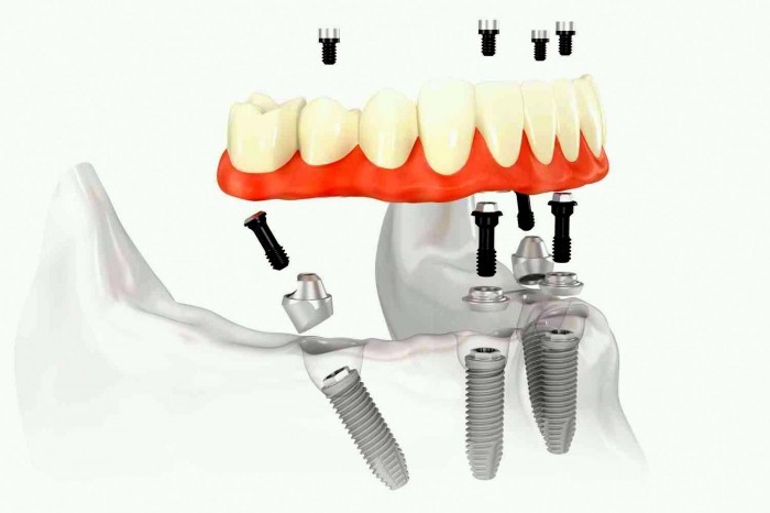 protetica dentară