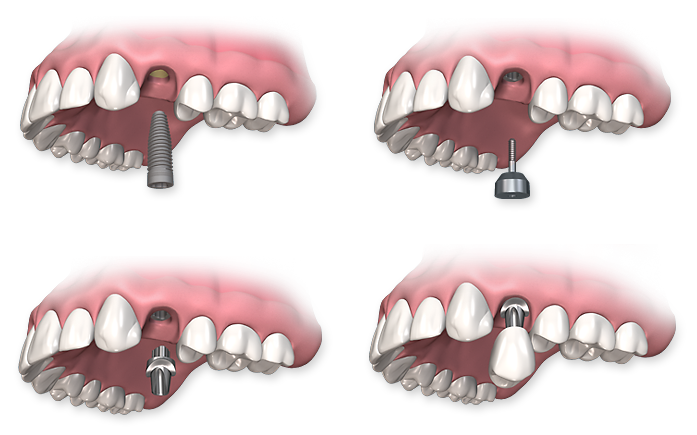 Implanturi dentare – 5 lucruri interesante despre acestea